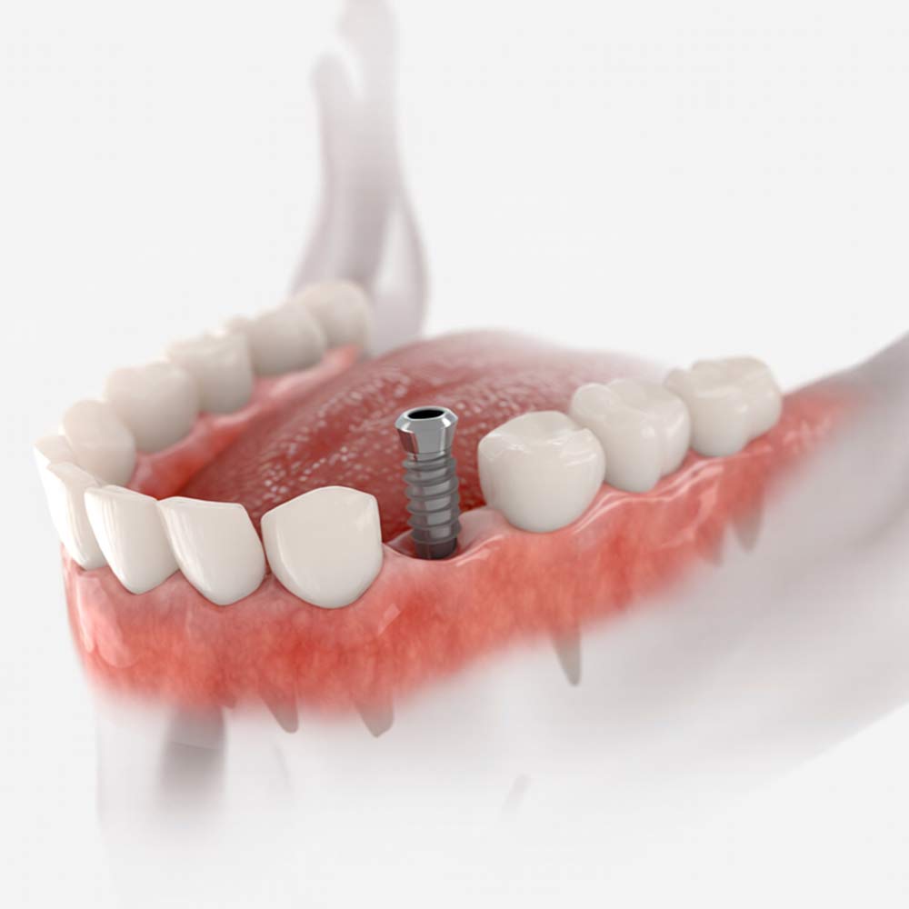 dental implant