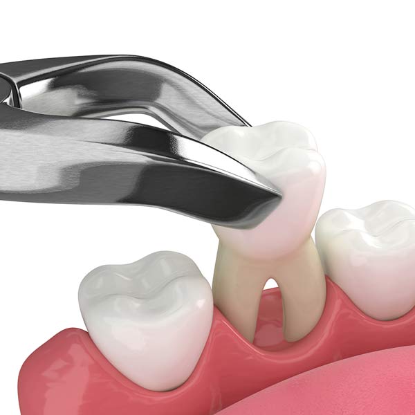 Extracted tooth