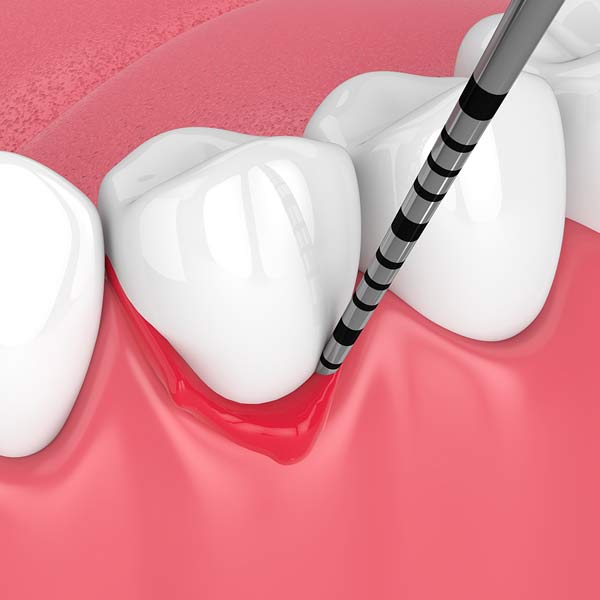 Woman looking at inflamed gums