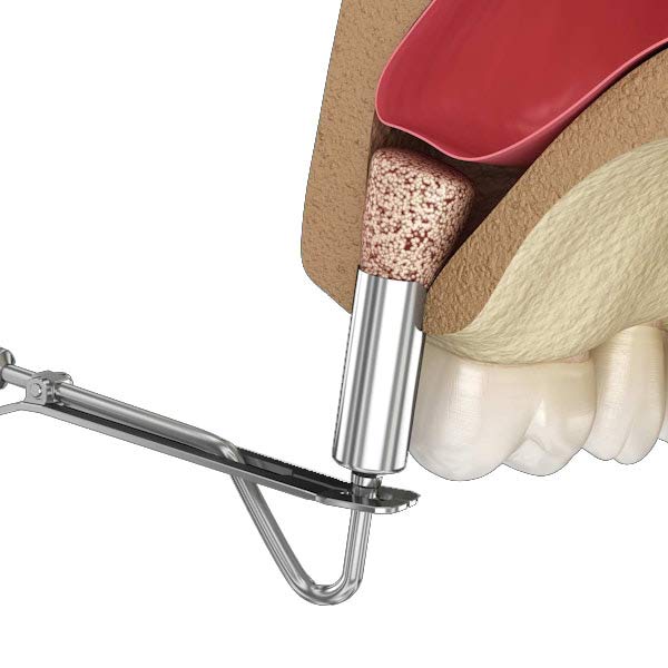Sinus Lift