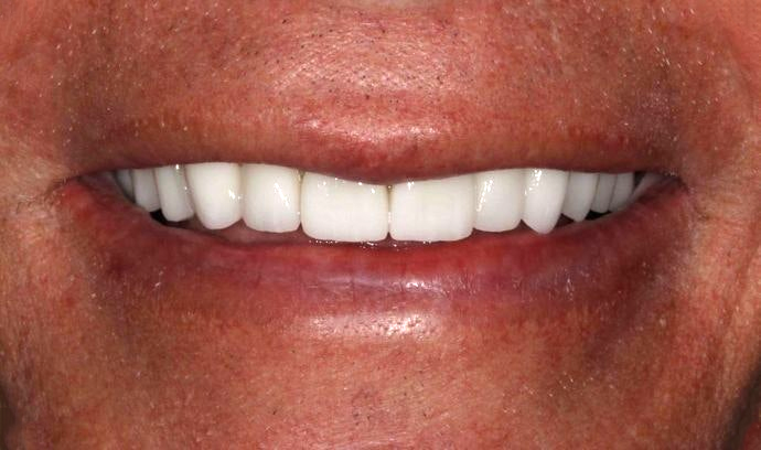 Precision Dental Partners Patient After Dental Implants