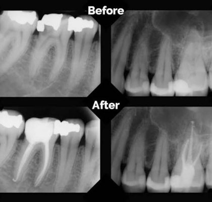 Root Canal X-Ray