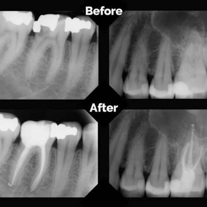 Root Canal X-Ray