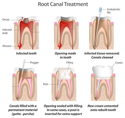 Root Canal Treatment