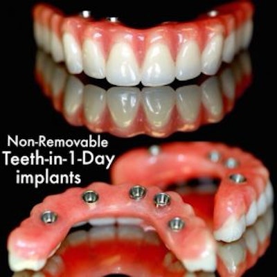 Dental Implants in Los Algodones Mexico