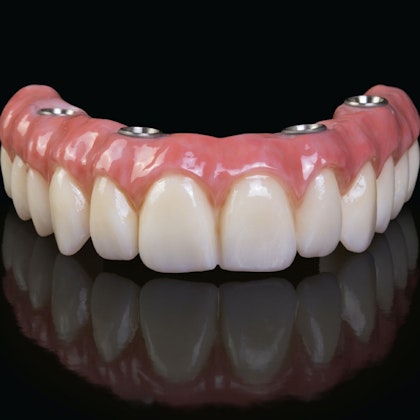 All-on-4 Dental Implants