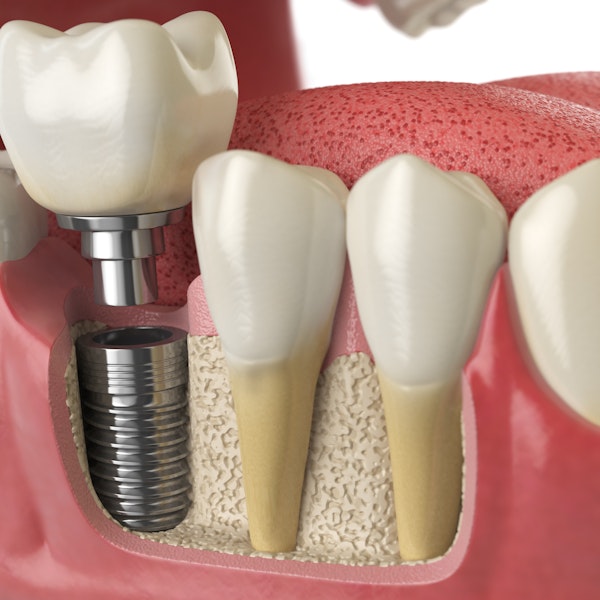 dental implant