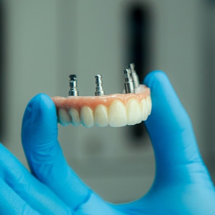 Dental implant denture