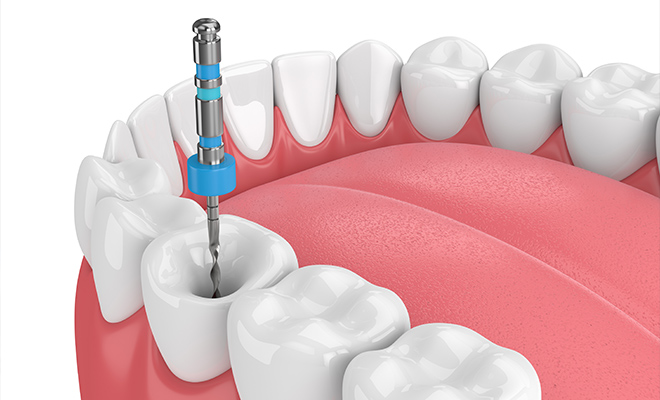 a 3d root canal illustration