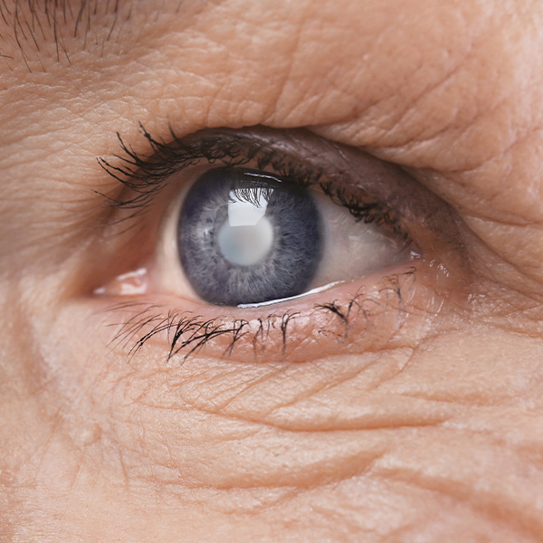 eye with cataract