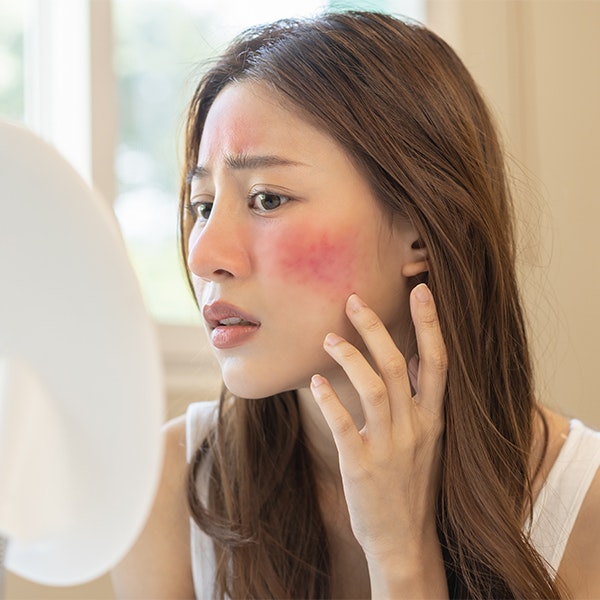 Young girl looking in the mirror worried about her rosacea