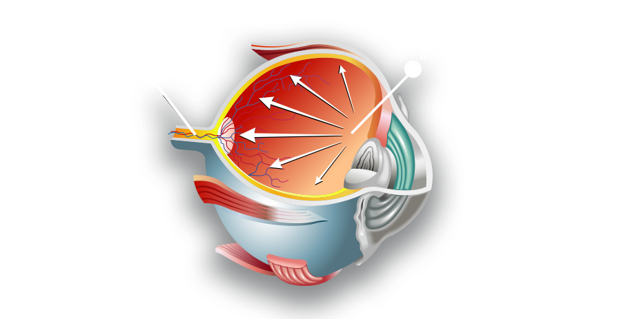 eye-diagram-glaucoma