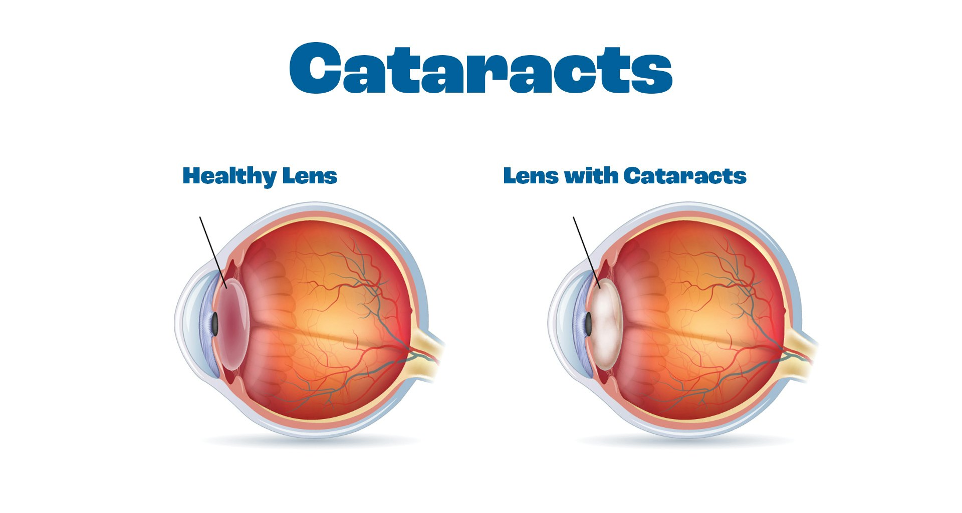Diagram comparing healthy eye and an eye with cataracts