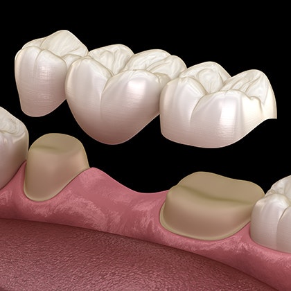 Traditional dental bridge