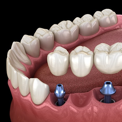 Implant-supported bridge
