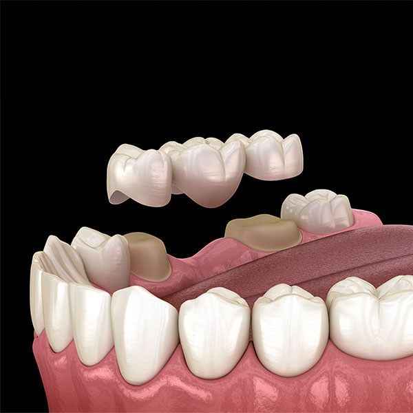 Illustration of a dental bridge