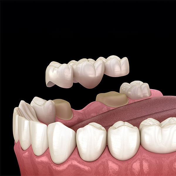 Illustration of a dental bridge