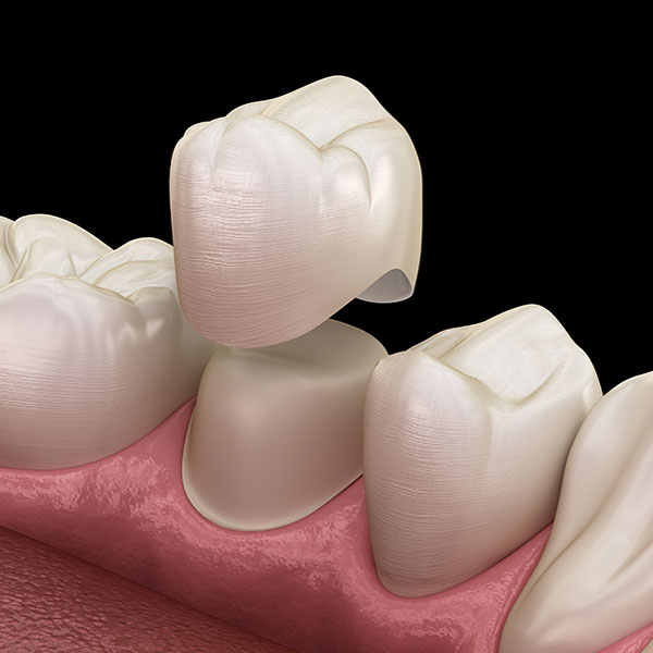 Illustration of a dental crown