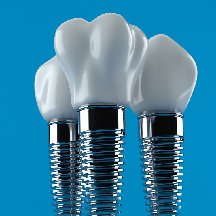 Allon4 Dental Implants Raleigh, NC North Carolina Implants and