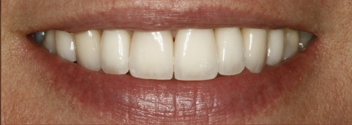 straight, white smile after cosmetic dentistry