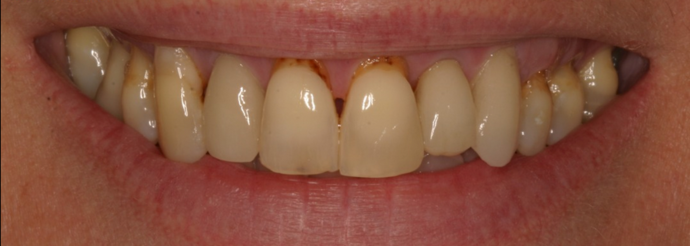 yellowed, misaligned smile before cosmetic dentistry
