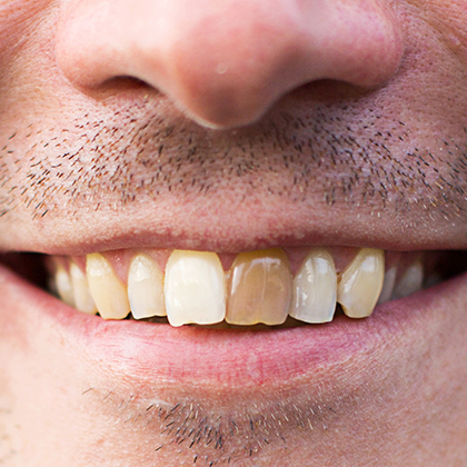 tooth with intrinsic stains