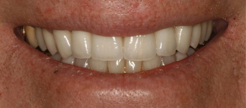 after smile makeover