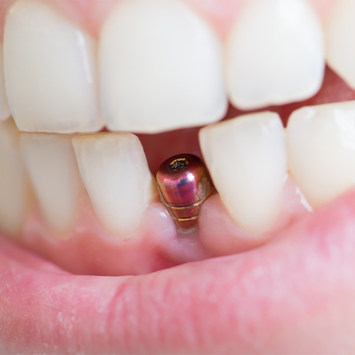 dental implants