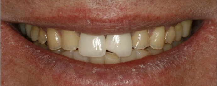 Before dental crowns