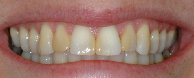 Link Dental patient before veneers