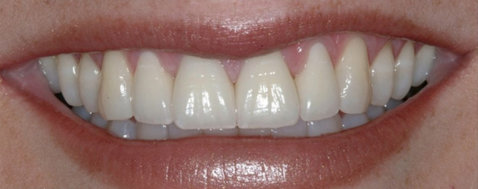 Link Dental patient after veneers