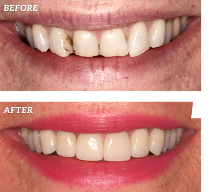 Link Dental patient before and after veneers