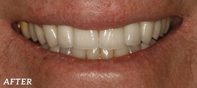 brighter, more even smile