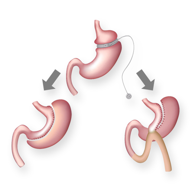Bariatric Revision Surgery
