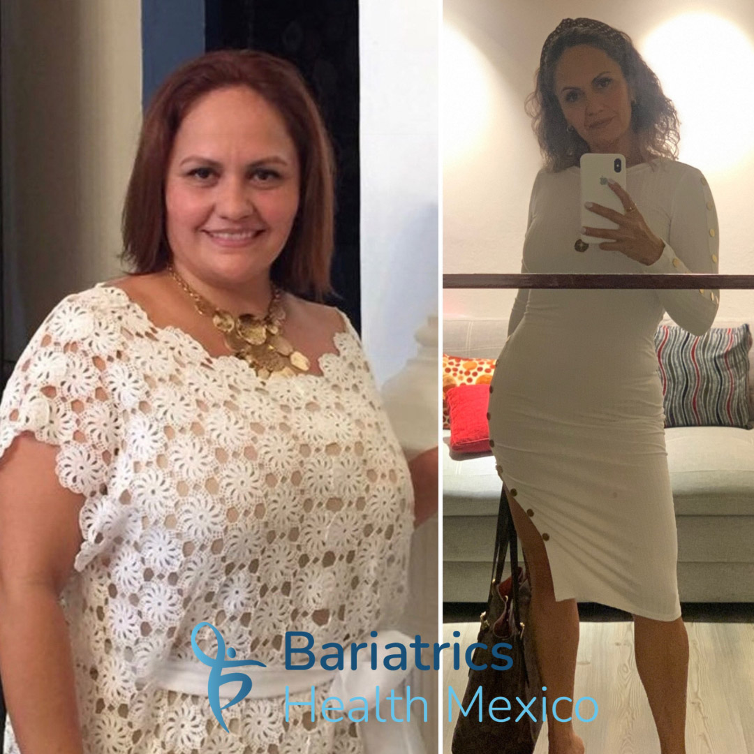 Medical tourism patient before and after bariatric surgery