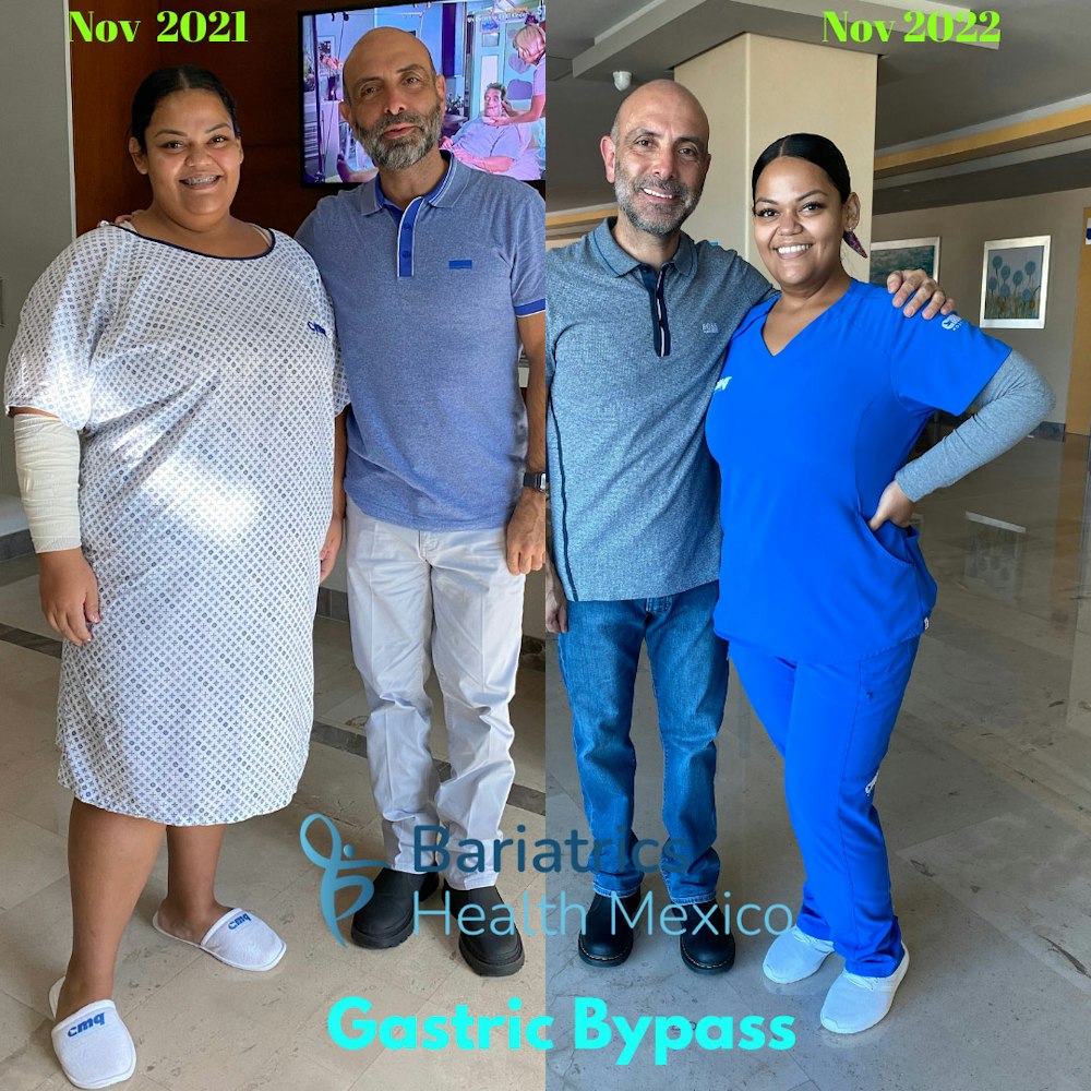 Before and after bariatric surgery