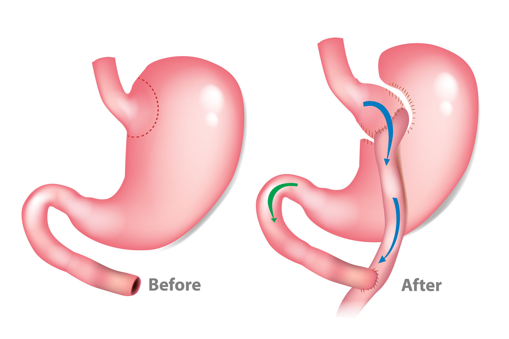 before and after gastric bypass