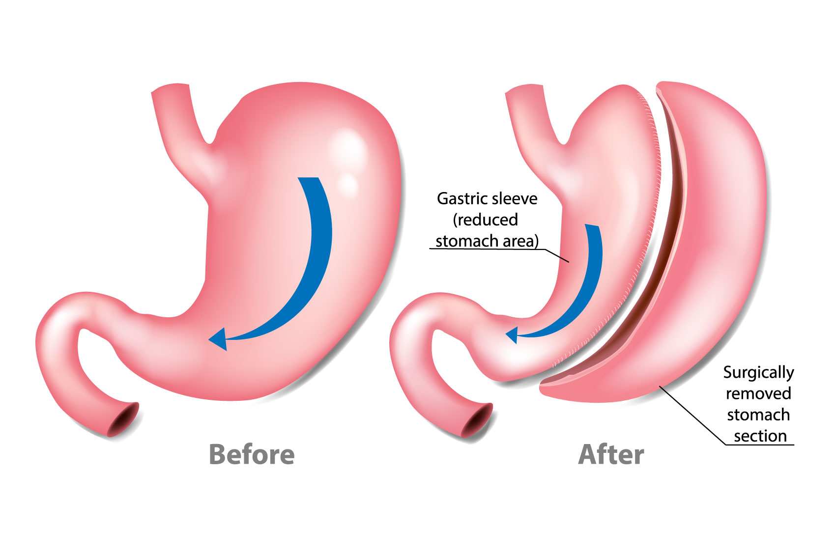 before and after sleeve gastrectomy (after illustration has the gastric sleeve (reduced stomach area) and the surgically removed stomach)