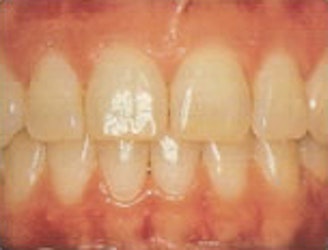 Healthy teeth and gums