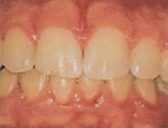 Teeth and gums with gingivitis, a little redness around the gum line