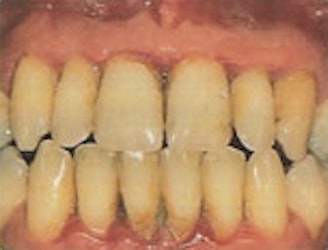 Teeth and gums with moderate periodontitis, teeth look long, gums are red and receded