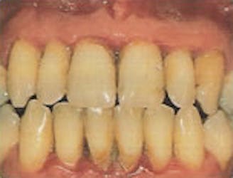 Teeth and gums with moderate periodontitis, teeth look long, gums are red and receded