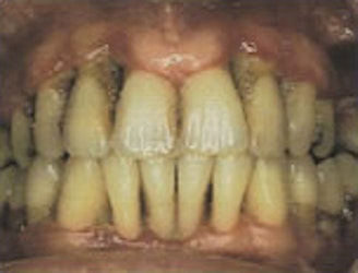 Teeth and gums with advanced periodontitis, teeth look long, some roots are visible, gums are very receded