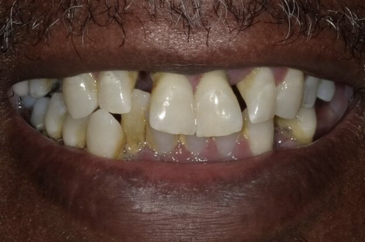 patient before dental implants