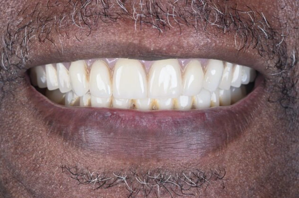 patient after dental implants