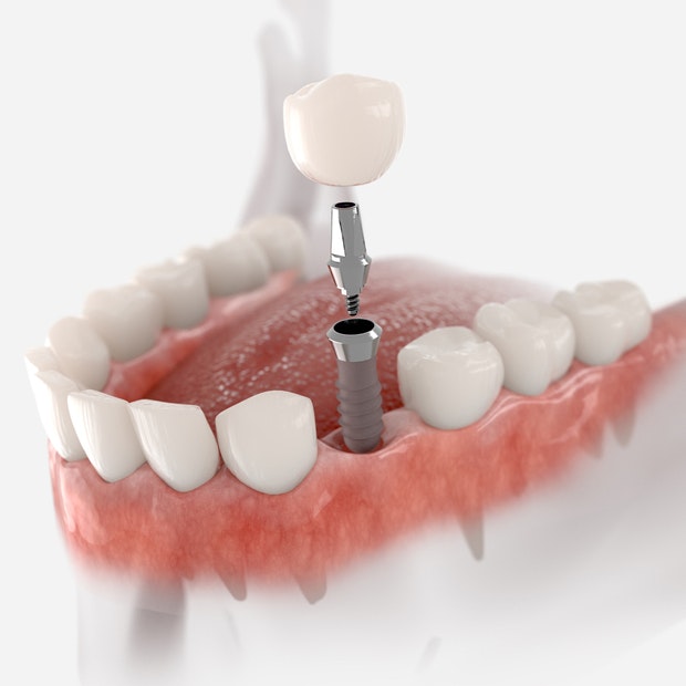 Implant, crown, and abutment being placed in jaw