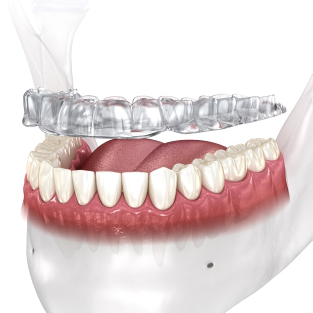 Clear aligner tray above bottom row of teeth