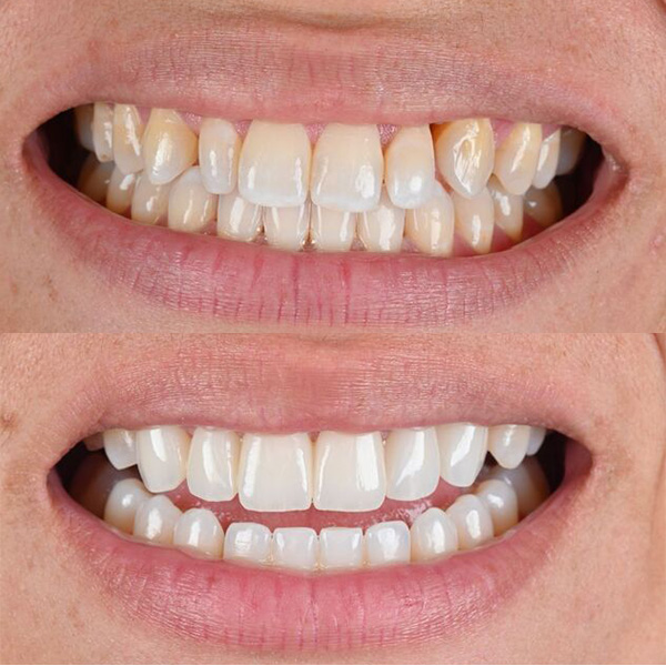 Our patients before and after veneers