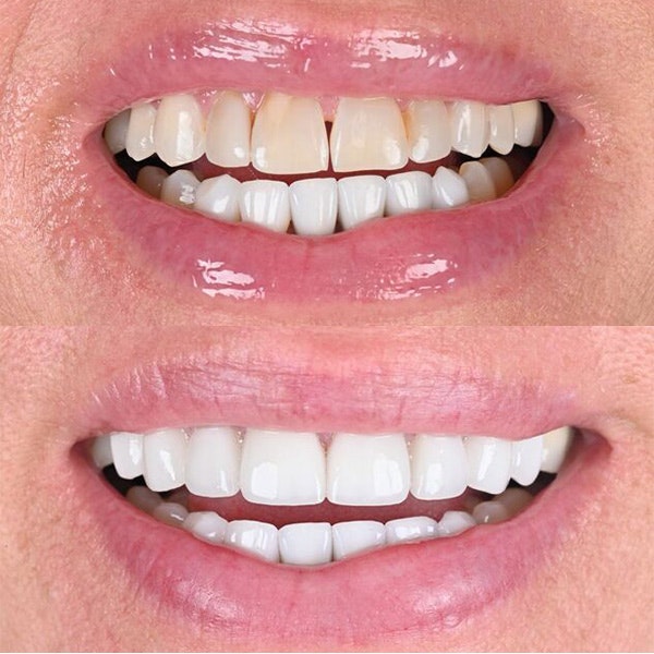 Our patient before and after crowns