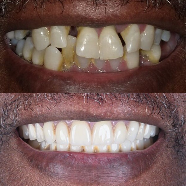 Before and After one of our patients received dental implants and dentures